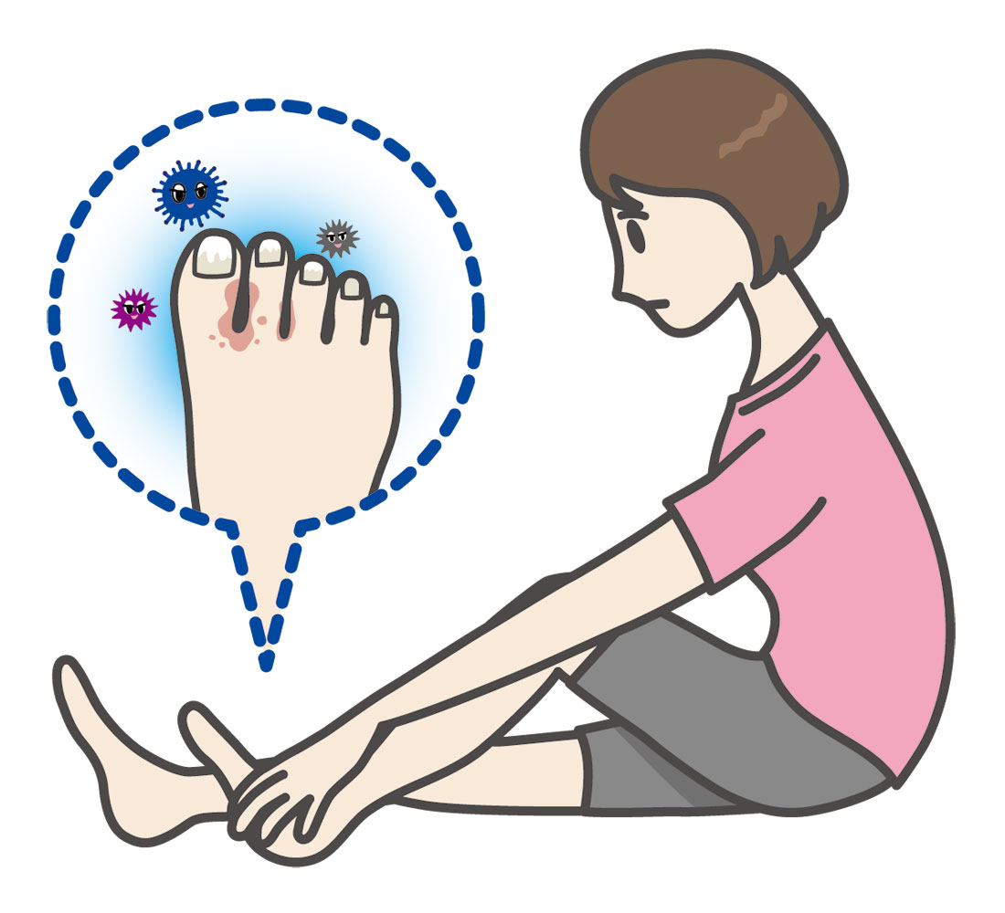 水虫かな？と思ったら